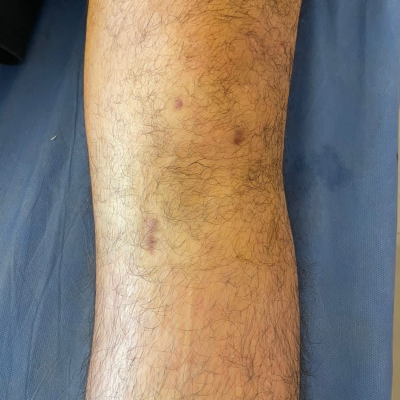 Dr. Eduardo Villanueva Manzo Plastía de ligamento cruzado