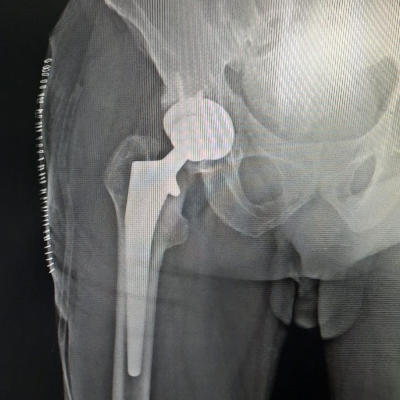 Dr. Eduardo Villanueva Manzo Prótesis de cadera