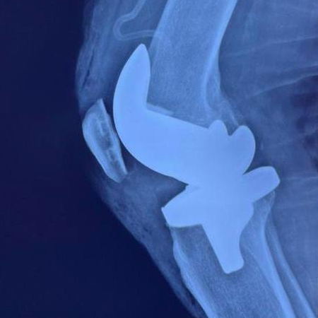 Dr. Eduardo Villanueva Manzo Prótesis de rodilla