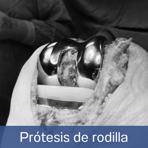 Dr. Eduardo Villanueva Manzo Prótesis de rodilla