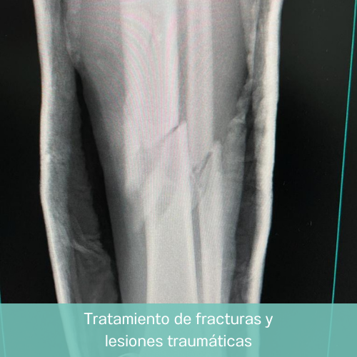 Dr. Eduardo Villanueva Manzo Tratamiento de fracruras